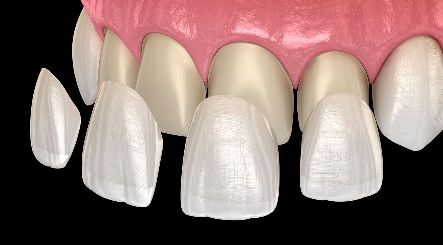 Facette Dentaire : Guide Simple pour un Sourire Plus Beau et Naturel