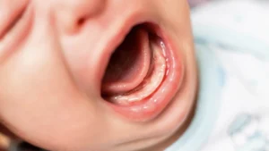 Pourquoi Chercher des Photos Gencives Poussée Dentaire Bébé en Ligne ?